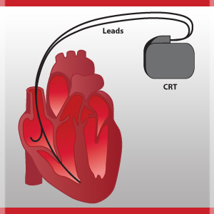 Vai trò của CRT trong điều trị suy tim hiện nay